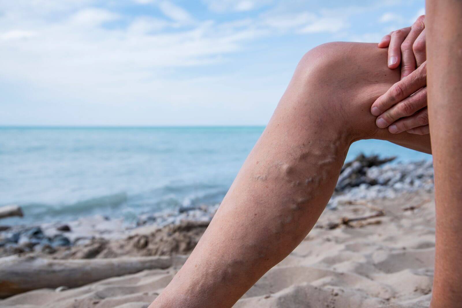 Treat Restless Legs Syndrome with 4 Effective Varicose Vein Treatments